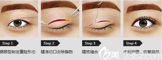 美莱美容医院杨继红切开双眼皮