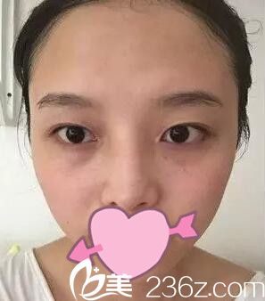 单眼皮术前照 单眼皮术前照