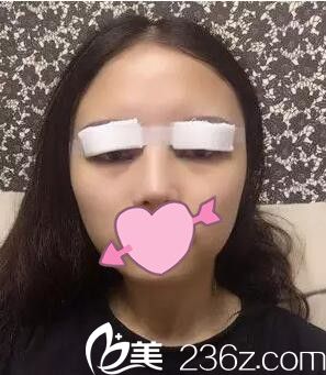 耿成虎做双眼皮术后天 耿成虎做双眼皮术后天