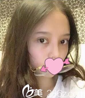 锦州斯美诺双眼皮术后第三天 锦州斯美诺双眼皮术后第三天