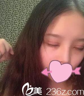 耿成虎做的双眼皮术后一周 耿成虎做的双眼皮术后一周