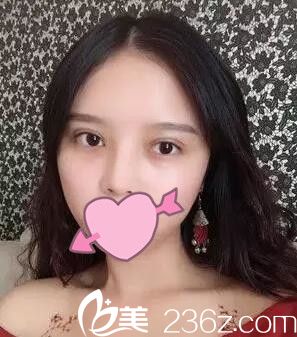 耿成虎做的双眼皮半个月效果 耿成虎做的双眼皮半个月效果