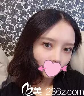 两个月前我面诊了锦州斯美诺整形医院耿成虎和周杰后我选择耿成虎做了全切双眼皮