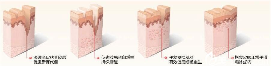美莱美容医院黄梦婷祛痘方法 美莱美容医院黄梦婷祛痘方法
