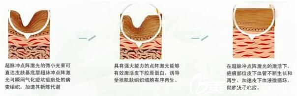 美莱美容医院黄梦婷祛痘原理 美莱美容医院黄梦婷祛痘原理