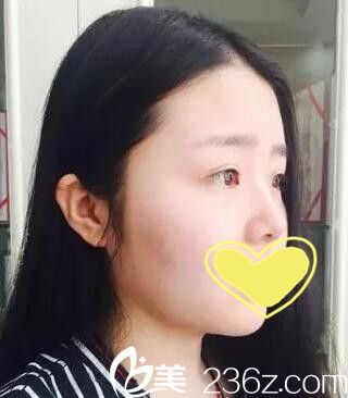 假体隆鼻术前照 假体隆鼻术前照