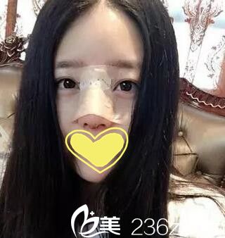 耿成虎鼻整形术后第二天 耿成虎鼻整形术后第二天