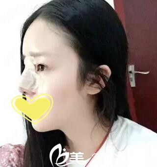 锦州斯美诺鼻整形第三天 锦州斯美诺鼻整形第三天