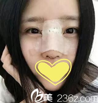 锦州斯美诺耿成虎鼻整形第六天 锦州斯美诺耿成虎鼻整形第六天