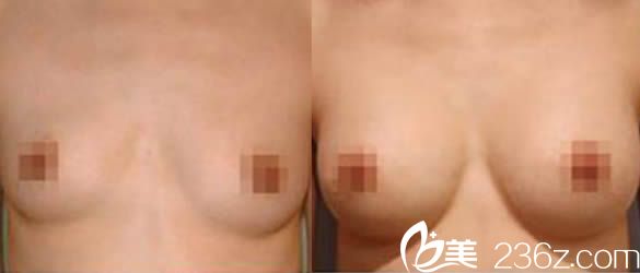 韩国瑞姿整形医院崔载英院长隆胸案例图 韩国瑞姿整形医院崔载英院长隆胸案例图