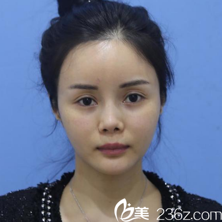 来广州紫馨做隆鼻和脂肪填充前的照片 来广州紫馨做隆鼻和脂肪填充前的照片