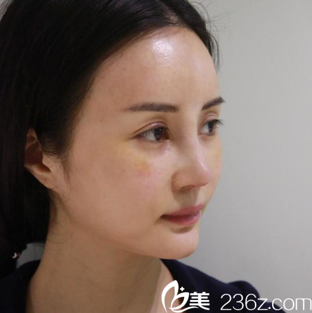 找广州紫馨金孝宪院长做完鼻综合隆鼻七天效果图 找广州紫馨金孝宪院长做完鼻综合隆鼻七天效果图