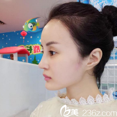 广州紫馨金孝宪院长为我做的隆鼻隆鼻和脂肪填充半个月自拍照片 广州紫馨金孝宪院长为我做的隆鼻隆鼻和脂肪填充半个月自拍照片