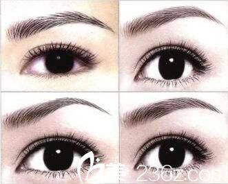 美莱美容医院梁桂英文秀类型 美莱美容医院梁桂英文秀类型