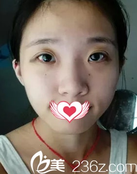 双眼皮术18天后完全消肿 双眼皮术18天后完全消肿