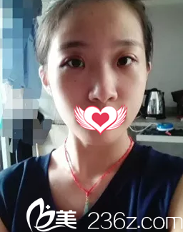 术后7天眼睛基本消肿 术后7天眼睛基本消肿