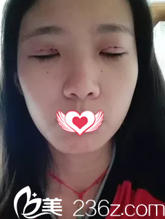 术后3天双眼皮微肿 术后3天双眼皮微肿