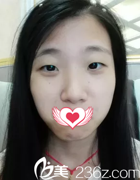 术前单眼皮小眼睛 术前单眼皮小眼睛