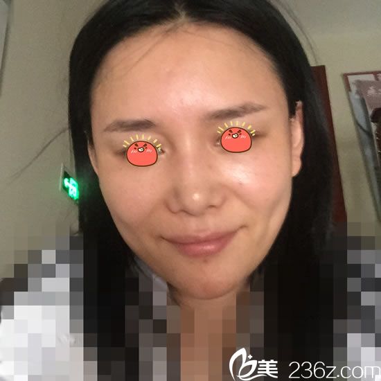 在宁波童颜做自体脂肪填充前 在宁波童颜做自体脂肪填充前