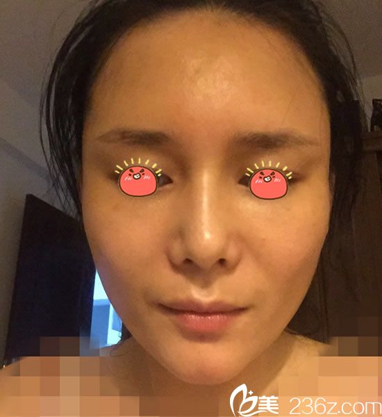 选择宁波童颜做脂肪填充4天<span style= 选择宁波童颜做脂肪填充4天<span style=