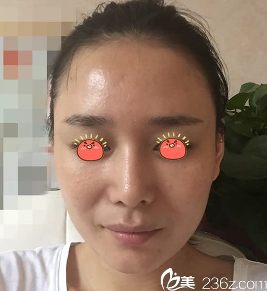 在宁波童颜做脂肪填充16天<span style= 在宁波童颜做脂肪填充16天<span style=