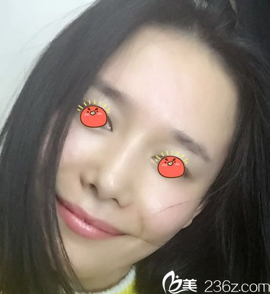 选择宁波童颜做脂肪填充2个月后 选择宁波童颜做脂肪填充2个月后