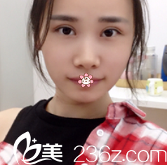 唐明芳双眼皮术后12天 唐明芳双眼皮术后12天