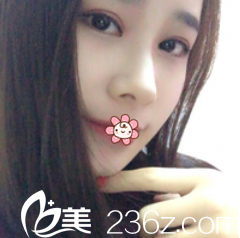 遵义利美康双眼皮手术一个月效果 遵义利美康双眼皮手术一个月效果