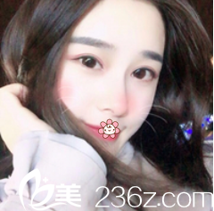 遵义利美康唐明芳双眼皮案例 遵义利美康唐明芳双眼皮案例