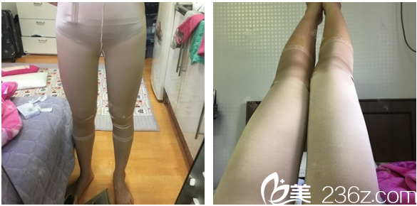广州曙光整形医院万友望大腿吸脂术后三天恢复照片