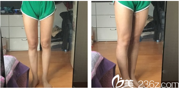 广州曙光大腿环吸脂术后七天恢复过程图