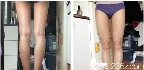 在广州曙光整形医院做完大腿抽脂一个月恢复图片