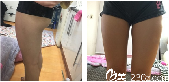 来广州曙光整形医院做大腿吸脂前的照片 来广州曙光整形医院做大腿吸脂前的照片