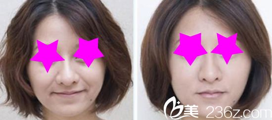 Channel整形医院面部除皱前后效果 Channel整形医院面部除皱前后效果