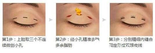 韩国黄金比整形外科金明国韩式双眼皮原理 韩国黄金比整形外科金明国韩式双眼皮原理