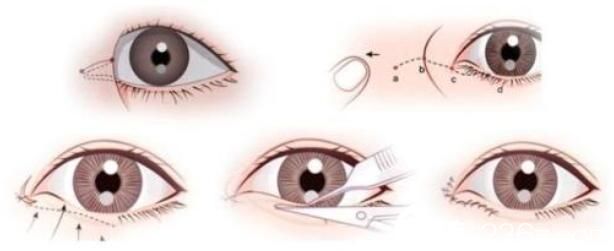 韩国黄金比整形外科金明国韩式双眼皮是的吗? 韩国黄金比整形外科金明国韩式双眼皮是的吗?