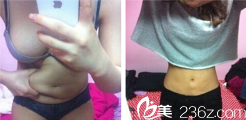 KIM JI CHOOL院长腹部吸脂案例 KIM JI CHOOL院长腹部吸脂案例