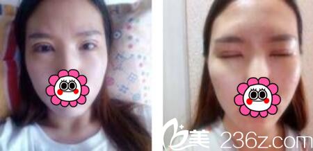 韩国黄金比整形外科金明国双眼皮真人案例术后第三天