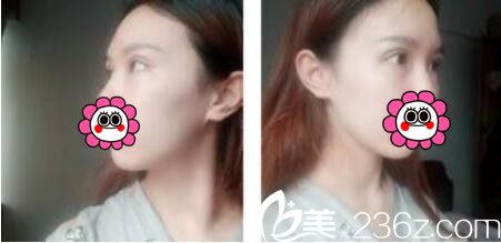 韩国黄金比整形外科金明国双眼皮真人案例术后第七天