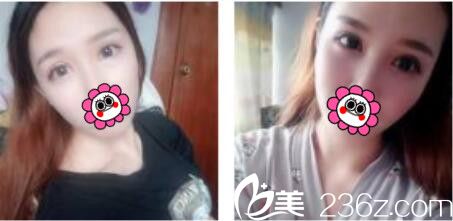 韩国黄金比整形外科金明国双眼皮真人案例术后十八天