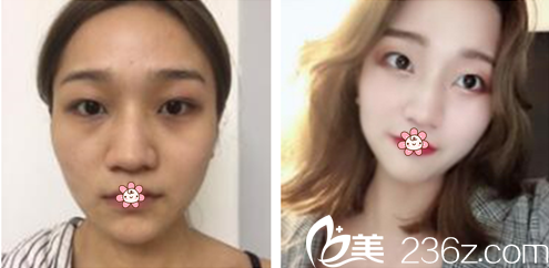 LEE CHONG RYANG院长自体脂肪面部填充案例