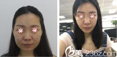 PARK SUNG GEO院长面部轮廓案例 PARK SUNG GEO院长面部轮廓案例