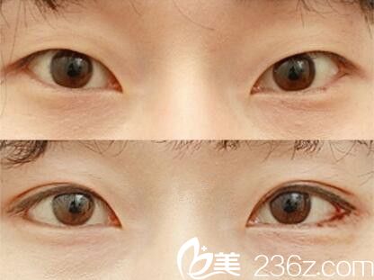 李重根眼综合真人案例对比