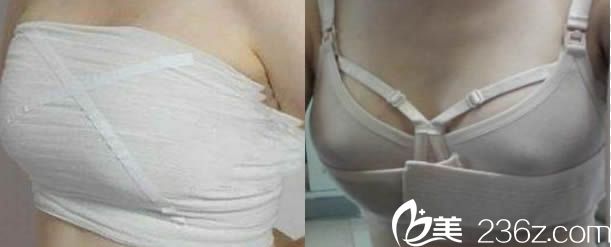 韩国瑞姿整形隆胸后穿塑胸内衣图 韩国瑞姿整形隆胸后穿塑胸内衣图