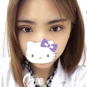 李重根做的双眼皮术后第三天