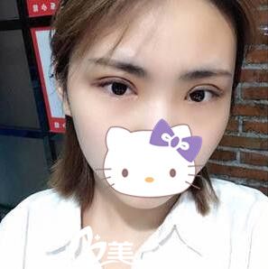 在韩国美line整形医院做双眼皮一周