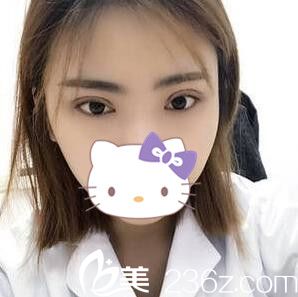 李重根做的双眼皮20天效果