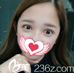 23天双眼皮恢复款窄适中 23天双眼皮恢复款窄适中