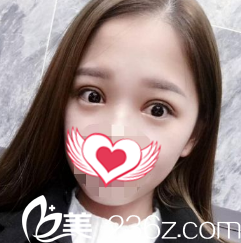 双眼皮术后15天消肿 双眼皮术后15天消肿