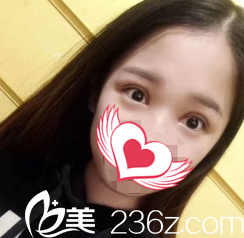 术后7天双眼皮拆线后的样子 术后7天双眼皮拆线后的样子